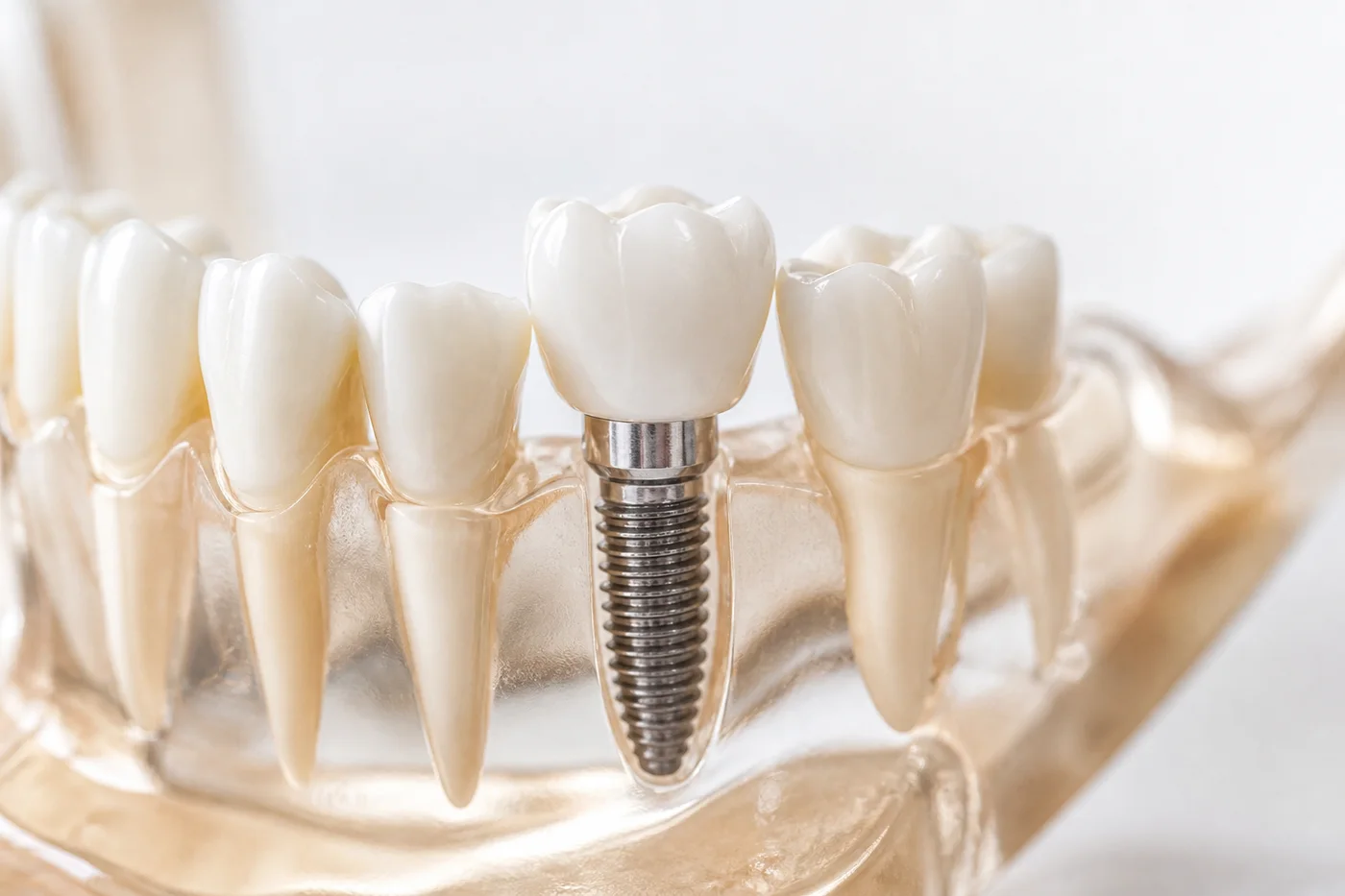 Control periodic implant dentar și evaluare parodontală în clinică Suceava