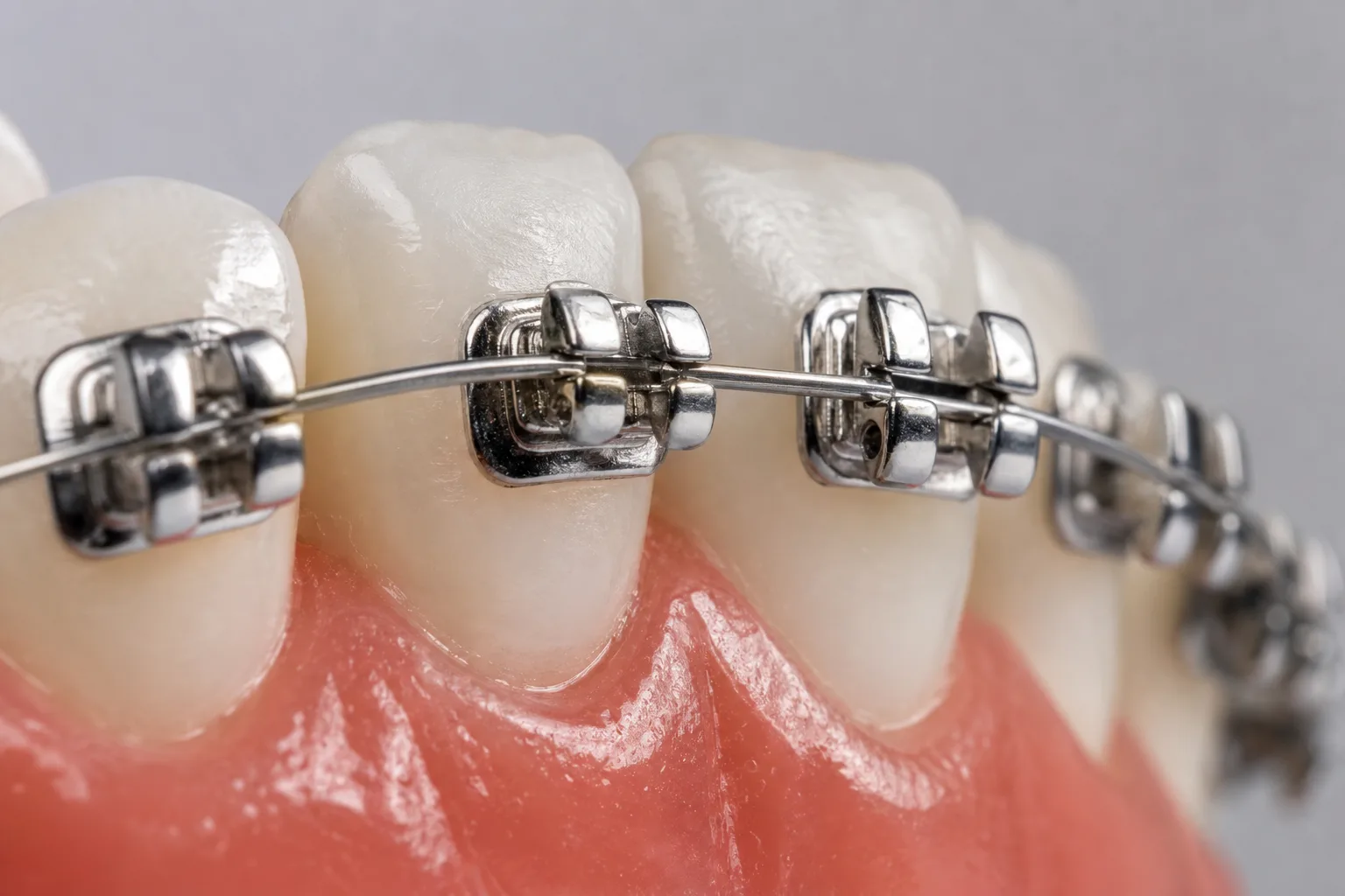 Aparat dentar Suceava Rose Dental Expert